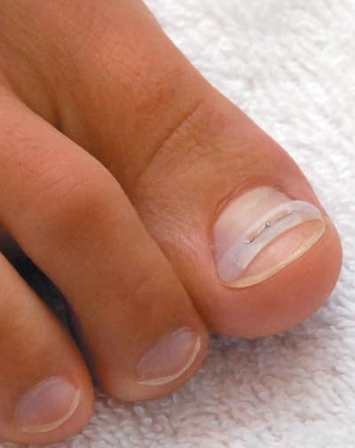 Ingroeiende nagels