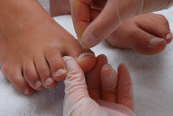 Ingroeiende nagels